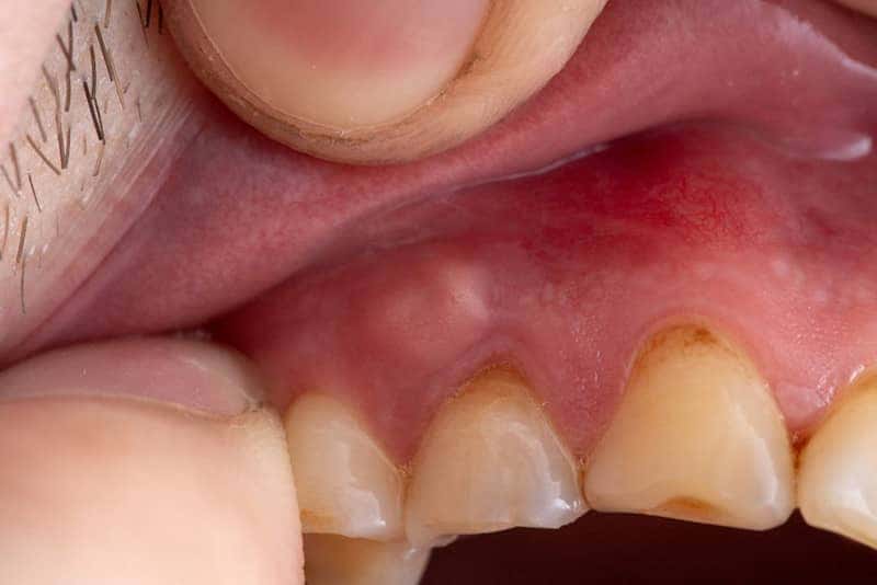 Khối áp xe trên nướu răng