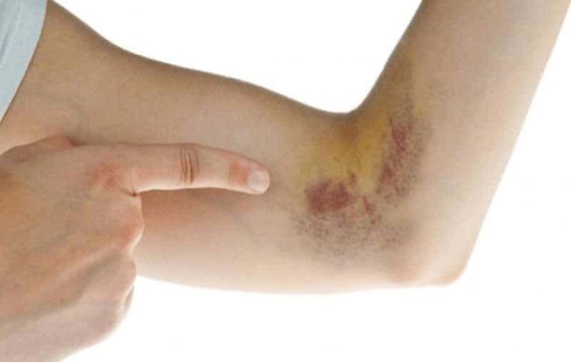 Sơ đồ chuyển màu của vết bầm tím sau chấn thương